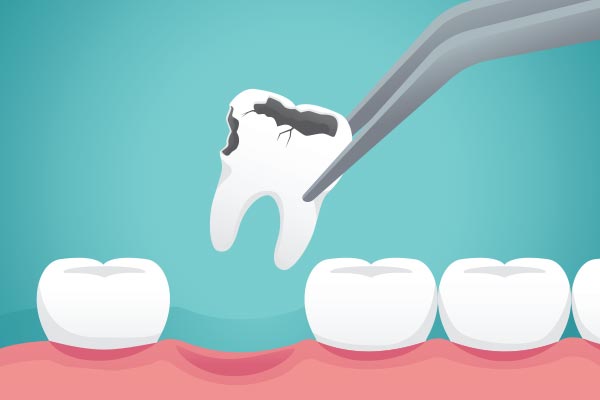 Ask a General Dentist: What Happens to Your Tooth After Extraction from R & R Dentistry PA in Delray Beach, FL