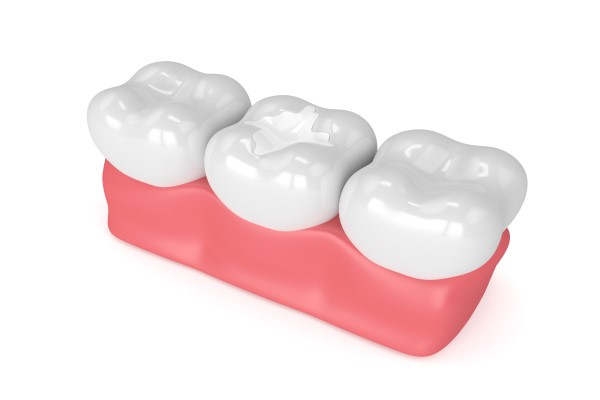 Benefits Of Dental Fillings