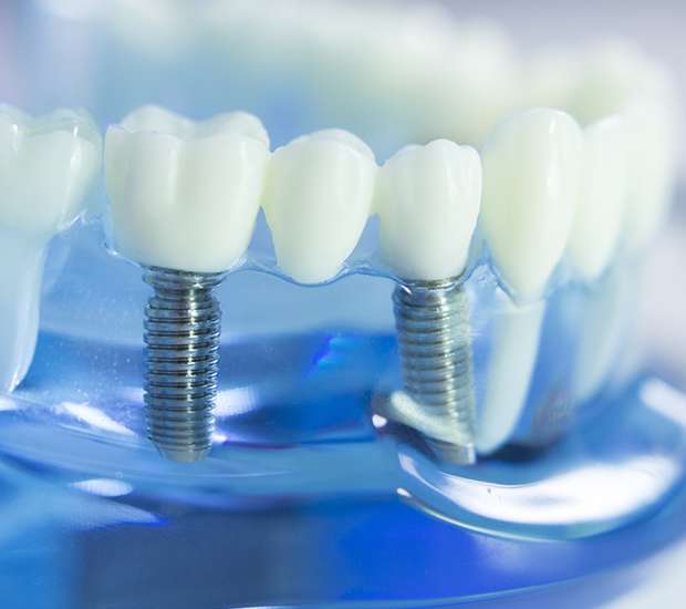 Delray Beach Dental Implants
