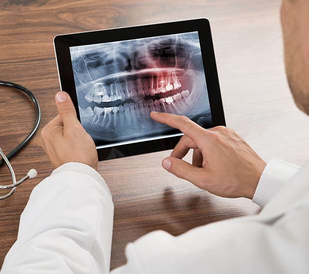 Delray Beach Types of Dental Root Fractures